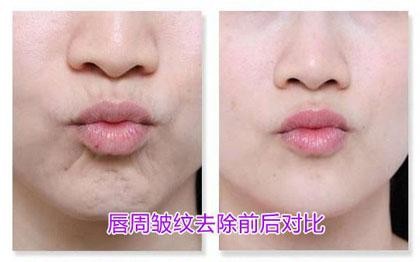 女人30岁脸上皱纹怎么除皱最安全,30岁的女人有皱纹有细纹怎么抗皱