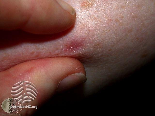 褐色皮肤纤维瘤会癌变吗,皮肤里面有个小的肿块会是什么