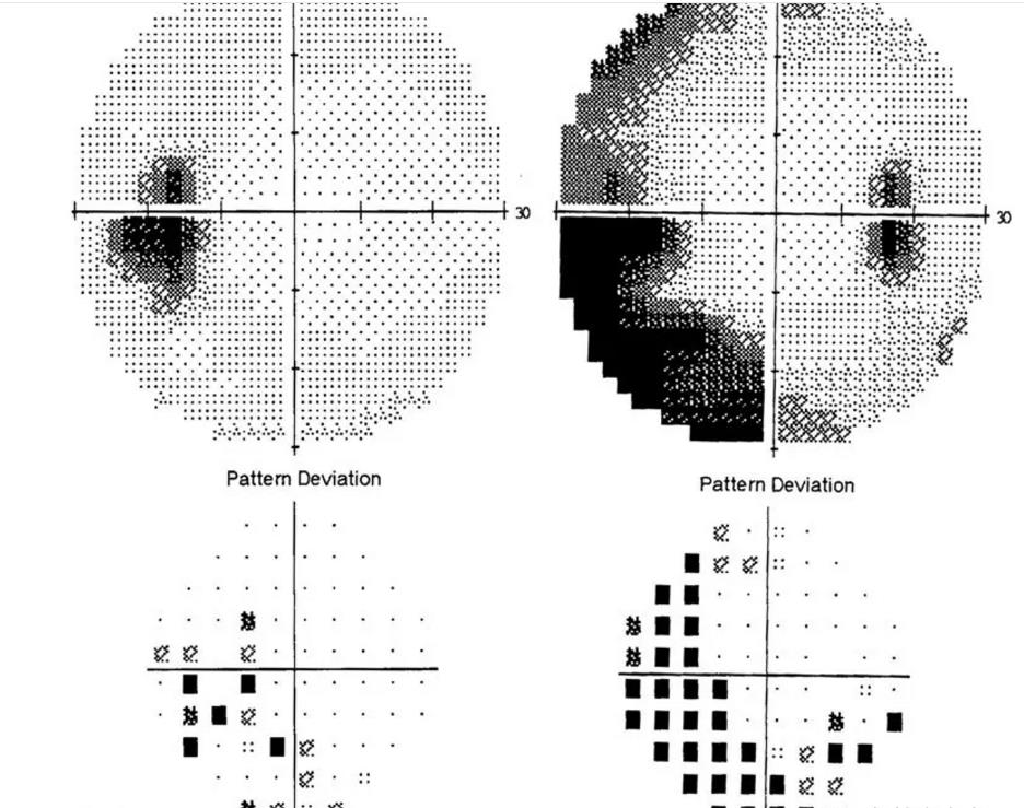 颅高压第一篇:视乳头水肿