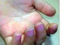 什么是川崎病,什么是川崎病小儿