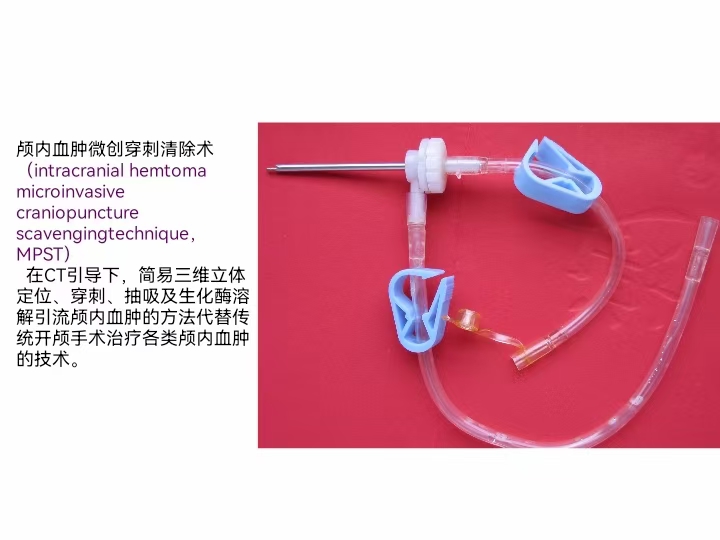 硬脑膜外血肿引流,高压氧治疗颅内出血