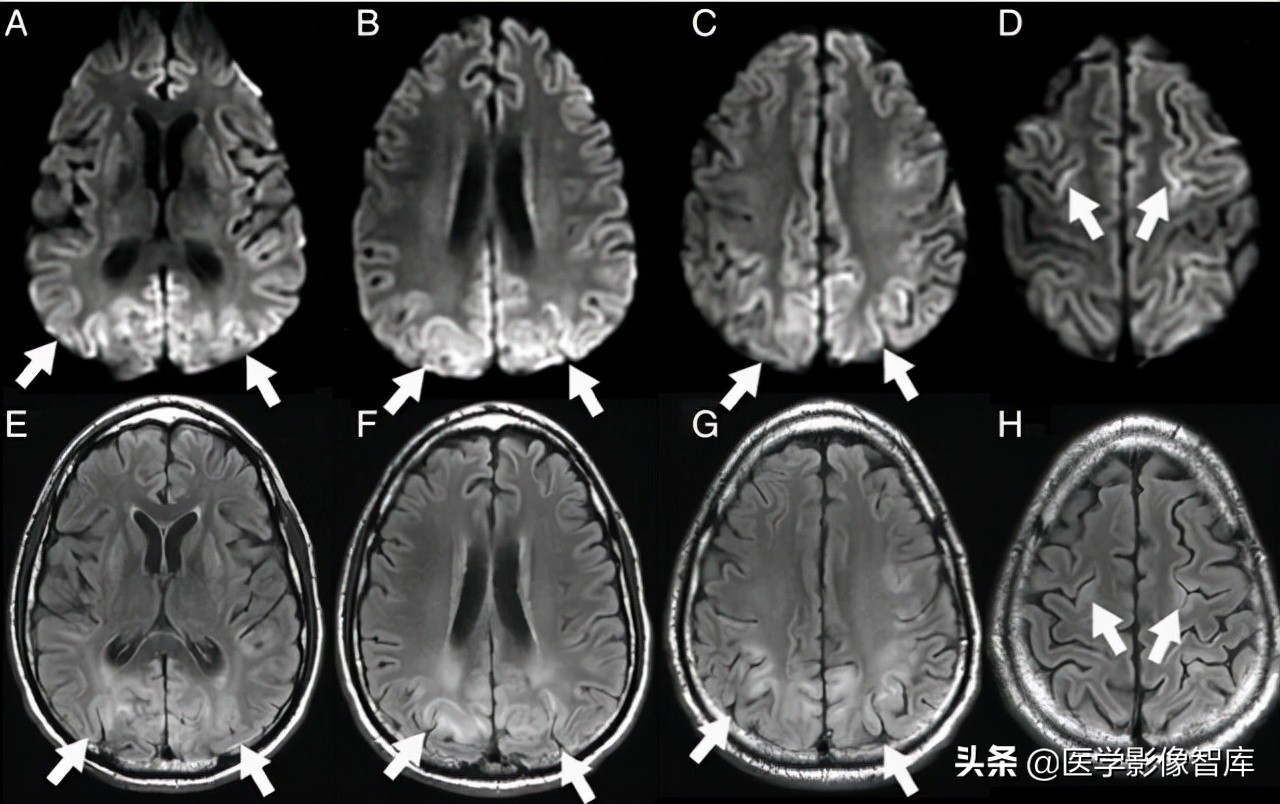 双侧额叶皮层区dwi偏高是什么意思,颅内dwi高信号病变