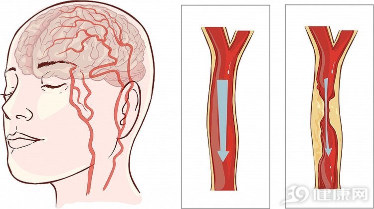 身体出现这些症状或是脑梗的表现,身体出现三个征兆是脑梗的前兆