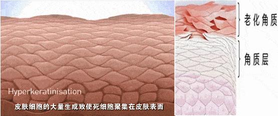 去角质和不去角质的区别,去角质与不去角质的对比