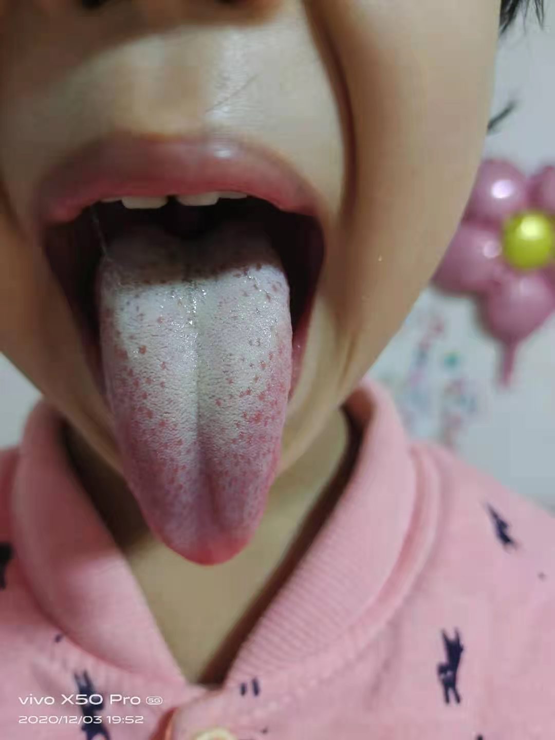 孩子有痰打呼噜是湿气重吗,孩子咳嗽痰多打呼噜