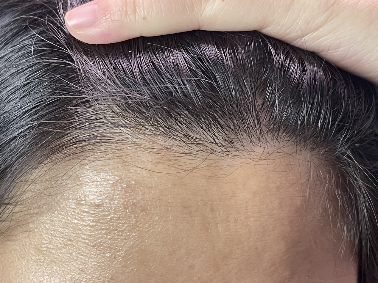 发际线保卫战如何打赢,发际线保卫战完整版