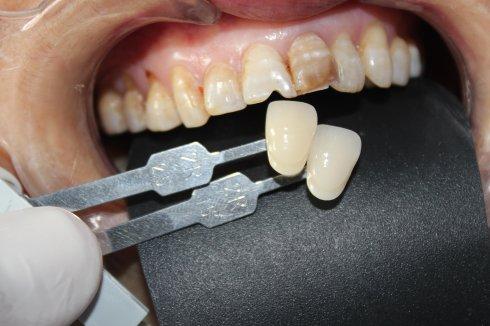 为什么中国人掉牙,为什么中国人寿命不长