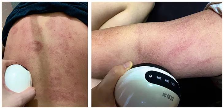 不用火的拔罐器视频,不用火自制拔罐神器