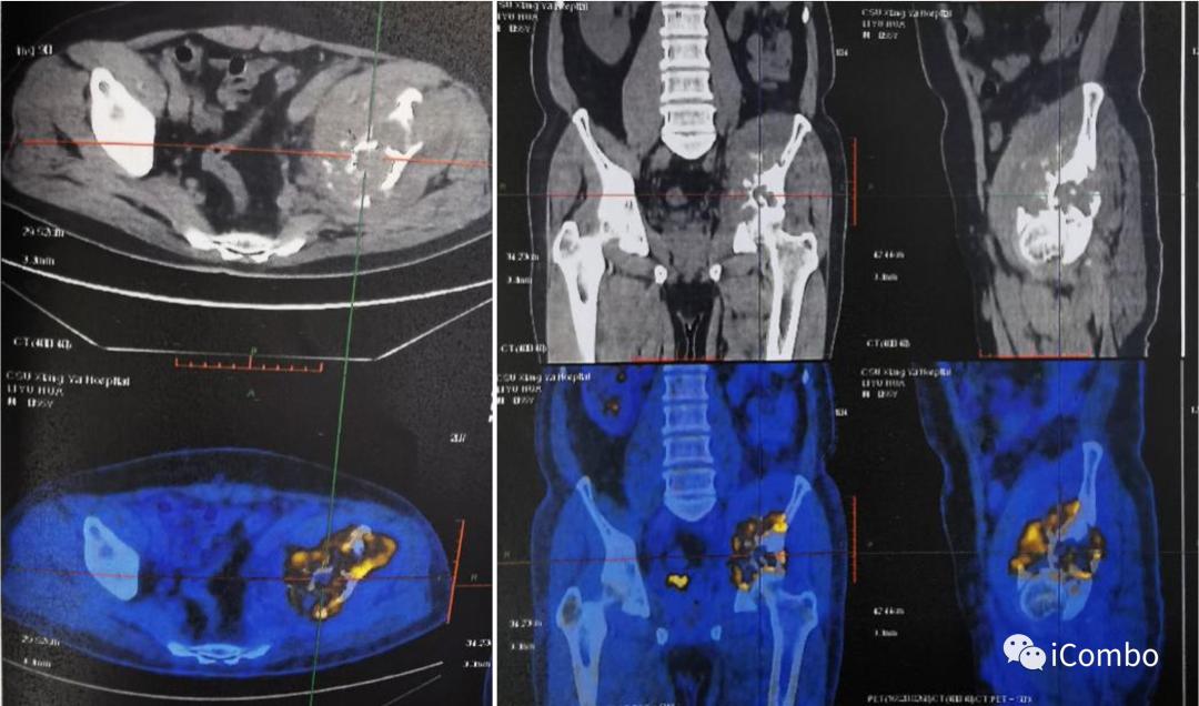 肾癌369例临床分析,恶性肾癌中晚期治疗方案