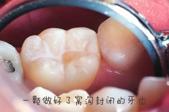 什么是儿童窝沟封闭？会不会痛？1分钟视频带你看懂#雅悦齿科#