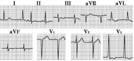 常见20种异常心电图及处理,常见20种异常心电图及特点