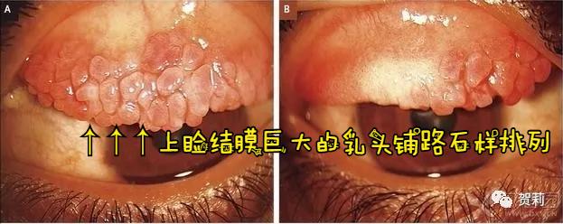 双眼痒伴有异物感、流泪,春夏之交换季眼痒之-“过敏性结膜炎”