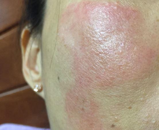 接触性皮炎全身起丘疹怎么办,淡红色丘疹性皮炎症状图片