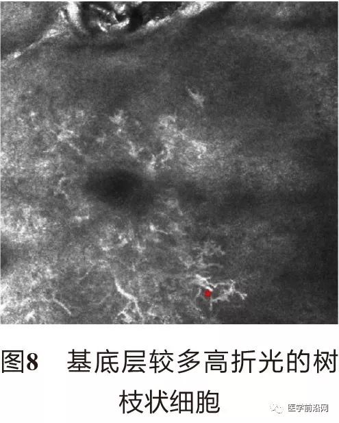 皮肤共聚焦显微镜能查什么,皮肤镜和共聚焦显微镜