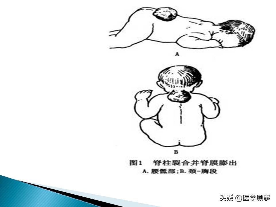 先天性脊柱裂是怎么来的,先天性脊柱裂的孕妇