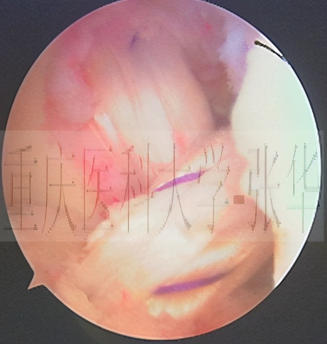 前交叉韧带损伤核磁共振,前后交叉韧带损伤的治疗