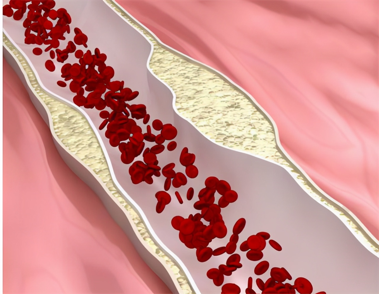 冠状动脉钙化和粥样硬化哪个严重,冠状动脉钙化和硬化哪个严重