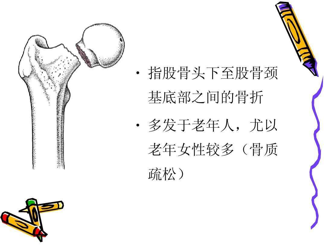 老年人发生股骨颈骨折，专家建议选择西医手术，不建议中医正骨