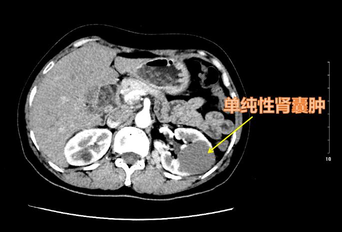囊性肾癌与囊肿的区别,复杂肾囊肿和囊性肾癌