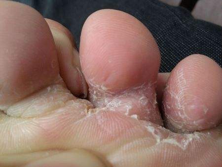 夏天脚气消失冬天脚气又有了,得了脚气香港脚有什么需要注意