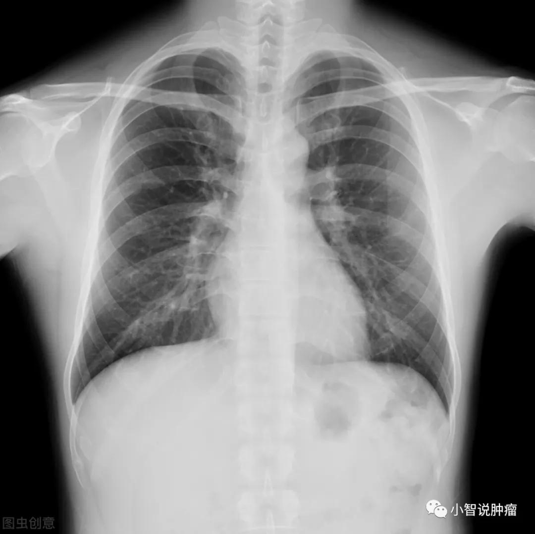 年年体检却查出癌晚期,年年体检正常却被诊断为癌症晚期