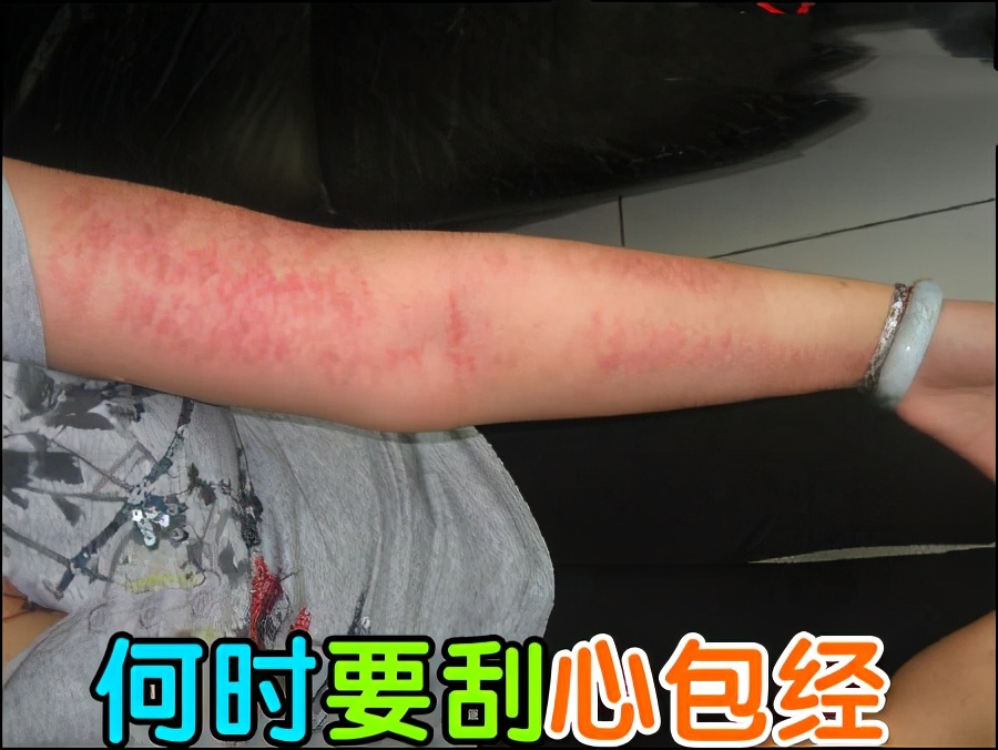 暴走后手肿是怎么回事,暴走之后筋疼