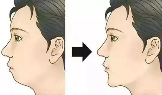 假体隆乳手术后的注意事项是哪些,假体隆下颌手术后注意事项