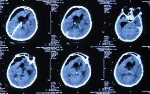 结核性脑积水,脑膜炎脑积水要治疗多久