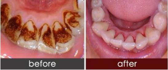 洗牙牙齿问题,医院口腔科洗牙和外面洗牙区别