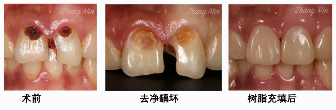 什么方法最适合去黄牙不伤牙齿,一口老黄牙怎么治疗