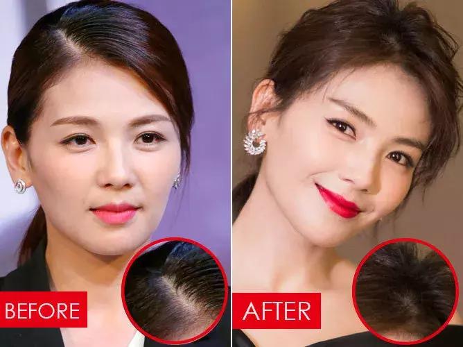 拯救发际线告别大额头,拯救发际线不走冤枉路