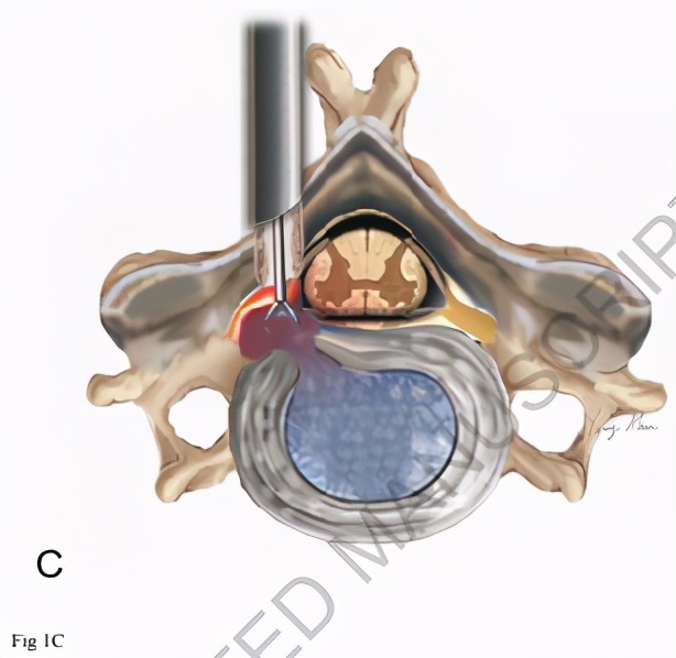 颈椎内窥镜手术效果,颈椎病内窥镜手术