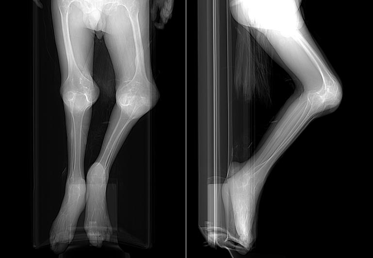 30岁强直性脊柱炎中医治愈案例,王永福院士治疗强直性脊柱炎案例