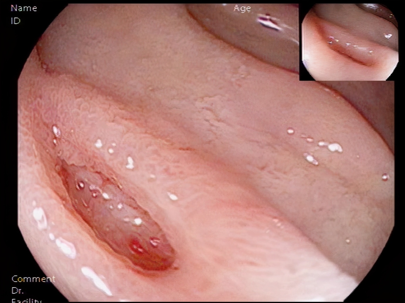 急性上消化道出血急诊诊治流程,上消化道出血快速救治通道