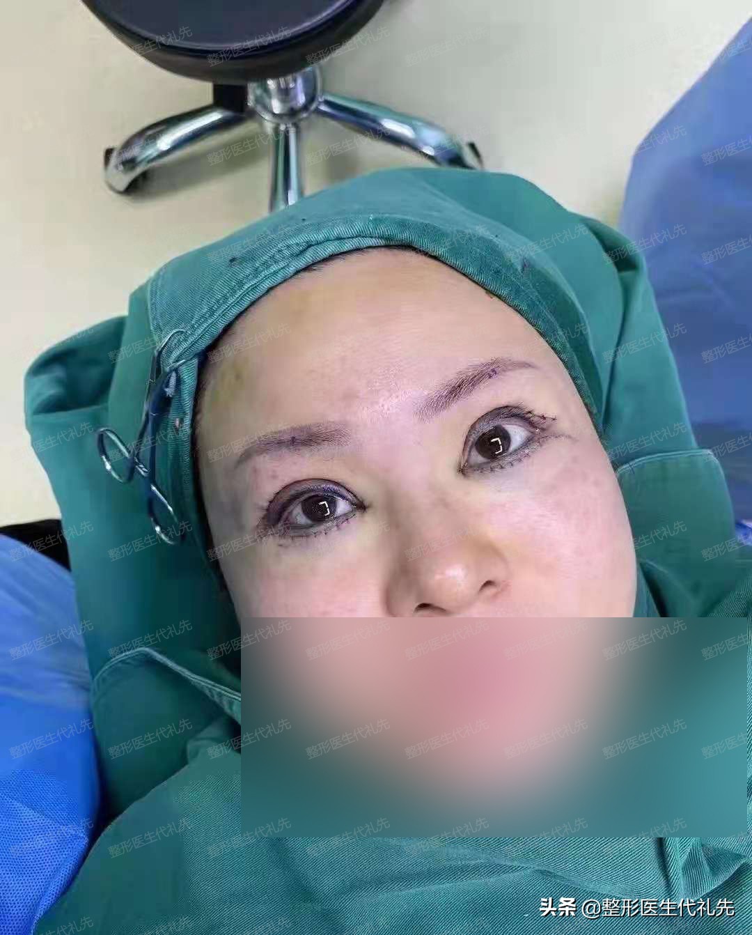 做全切双眼皮去眼袋恢复过程,45岁全切双眼皮亲身经历