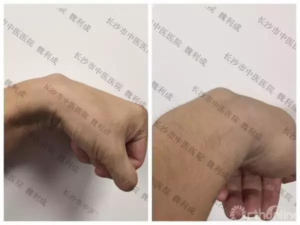 手腕囊肿抽吸出来后可否继续按压,足背囊肿穿刺好还是切除好