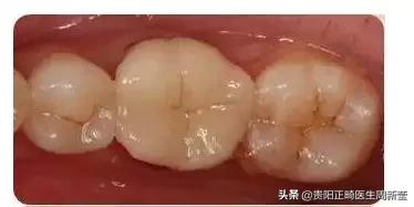 牙疼淋巴肿大是什么原因引起的,牙疼白天不疼晚上疼是什么原因