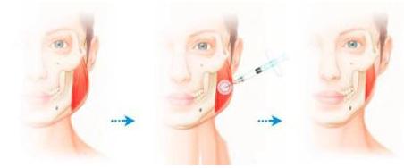 瘦脸针怎么避开腮腺,瘦脸针僵硬感怎么解决