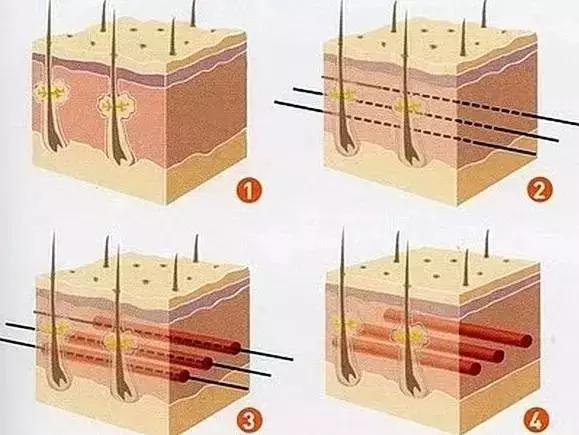 线雕一般多久做一次比较好,线雕多做几次维持的时间会越长吗