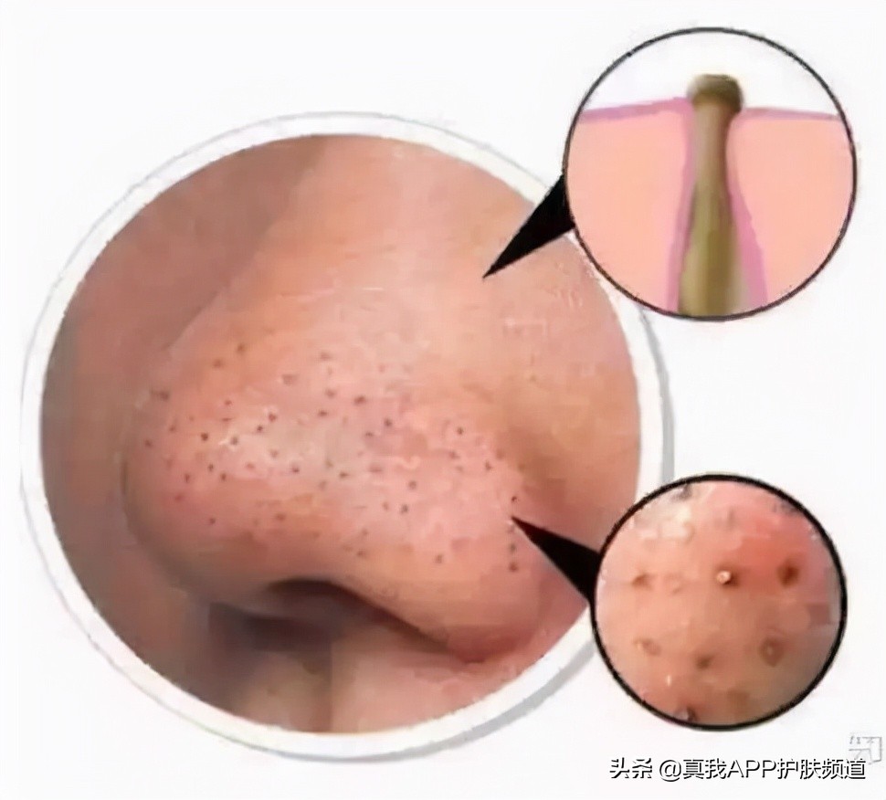 强效去黑头方法,去黑头大科普教你正确去黑头