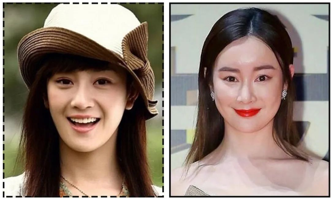 娄艺潇填充脂肪前后对比,娄艺潇填充前后对比