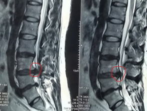 腰椎间盘突出牵引更疼是怎么回事,腰椎间盘突出牵引副作用