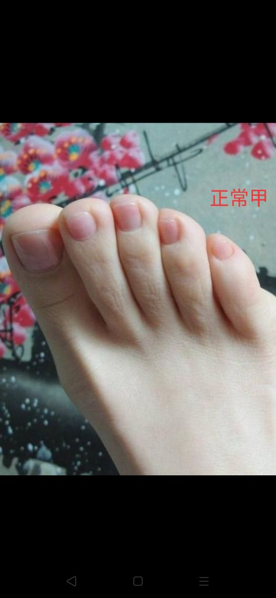 为什么很多人小脚趾的指甲好难看,为什么有的人小脚趾指甲很奇怪