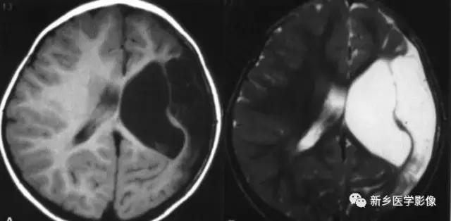 脑室为什么会扩张,脑室为什么会变小