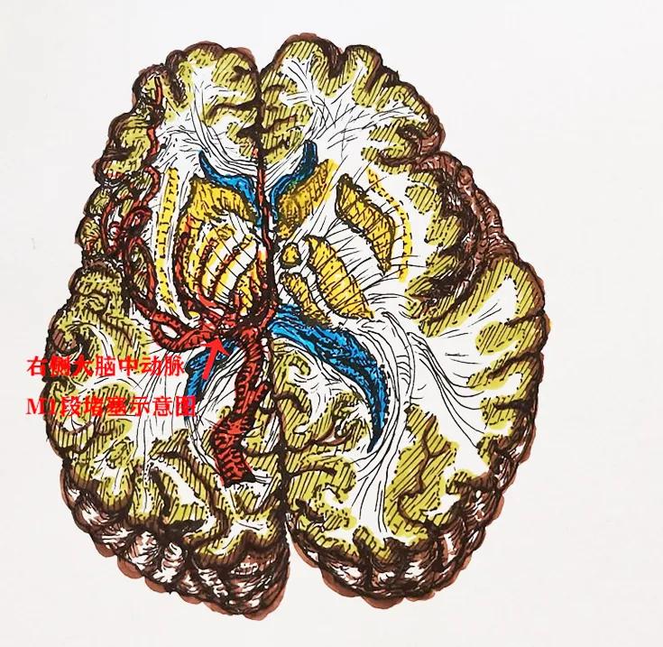 八字针法治疗脑中风后遗症,脑中风后遗症董氏针灸