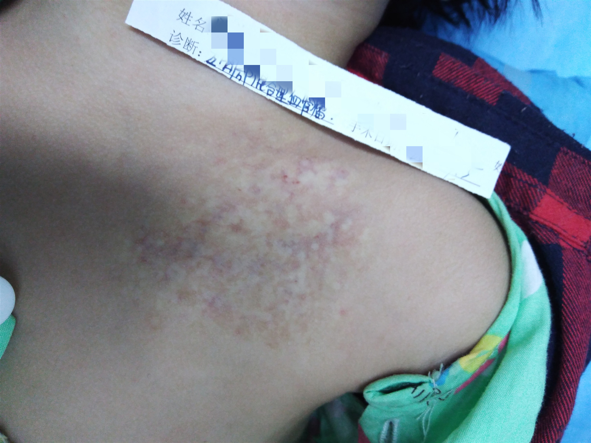 乳房血管瘤用什么方法治最好,乳房上有樱桃状血管瘤怎么治