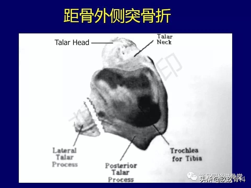 距骨骨折的治疗原则,距骨骨折如何调理