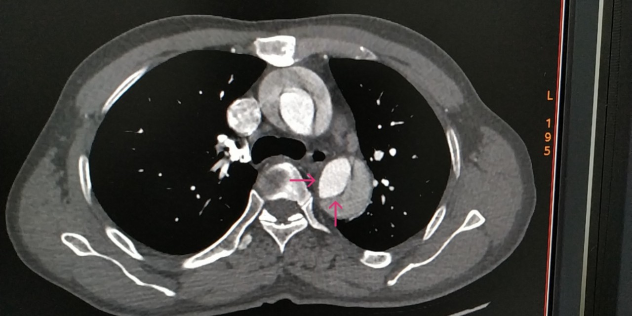 d-二聚体测定正常吗,颠覆认知免费阅读全文