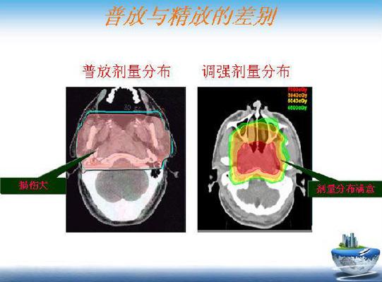 放射治疗射线作用时间,放射激光治疗
