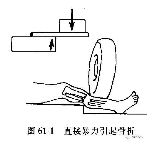 骨科急救处理流程图,骨科急救原则及注意事项